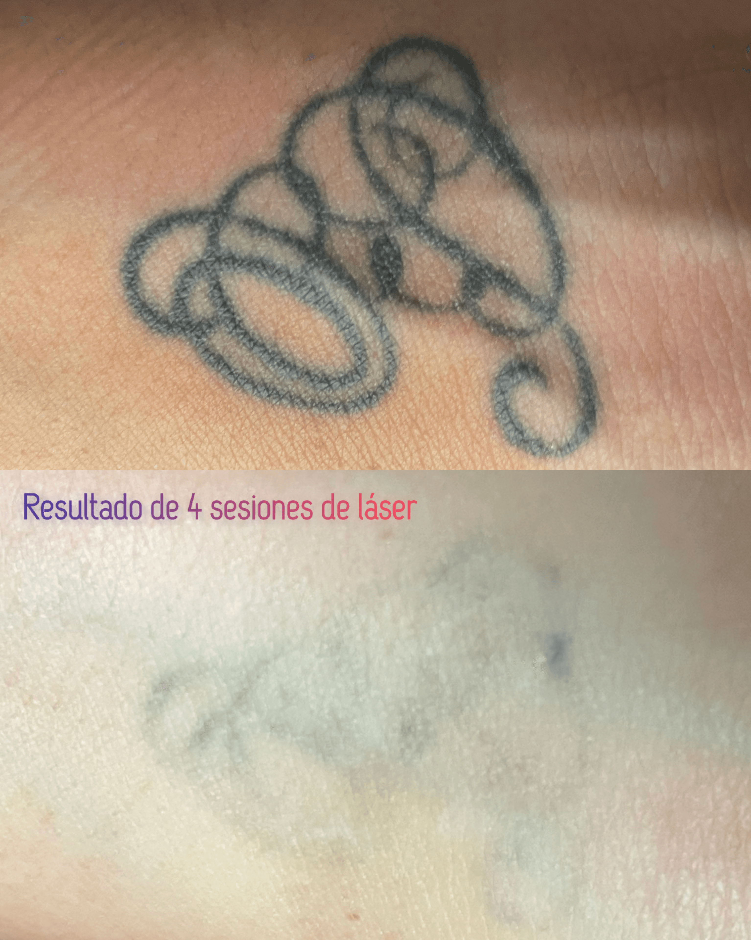 Láser 5